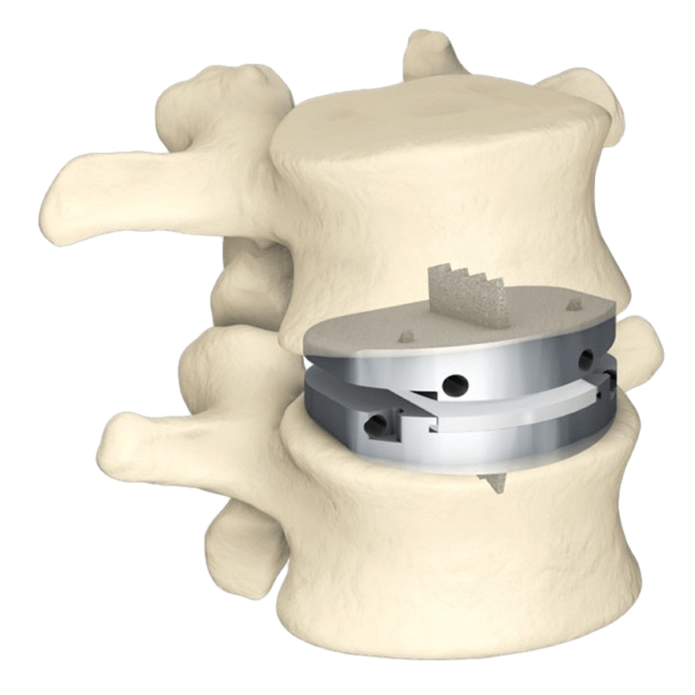 Восстановление межпозвонковых дисков. Межпозвоночный Кейдж. Кейдж межпозвонковый. Stryker межпозвоночные Дикси. Медтроник протез межпозвонковых диска.