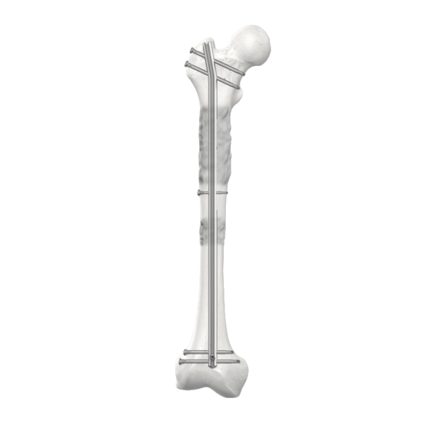 Precice® Bone Transport - Défects Osseux - Spinaxis